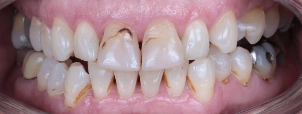 2 Before Dental Veneers Porcelain V