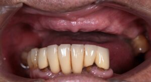 Mr A.M - Upper all on X 1 Before Dental Implants