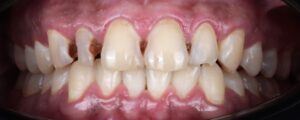 1 Composite V Before