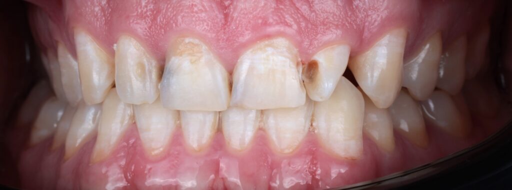 2 Composite V Before