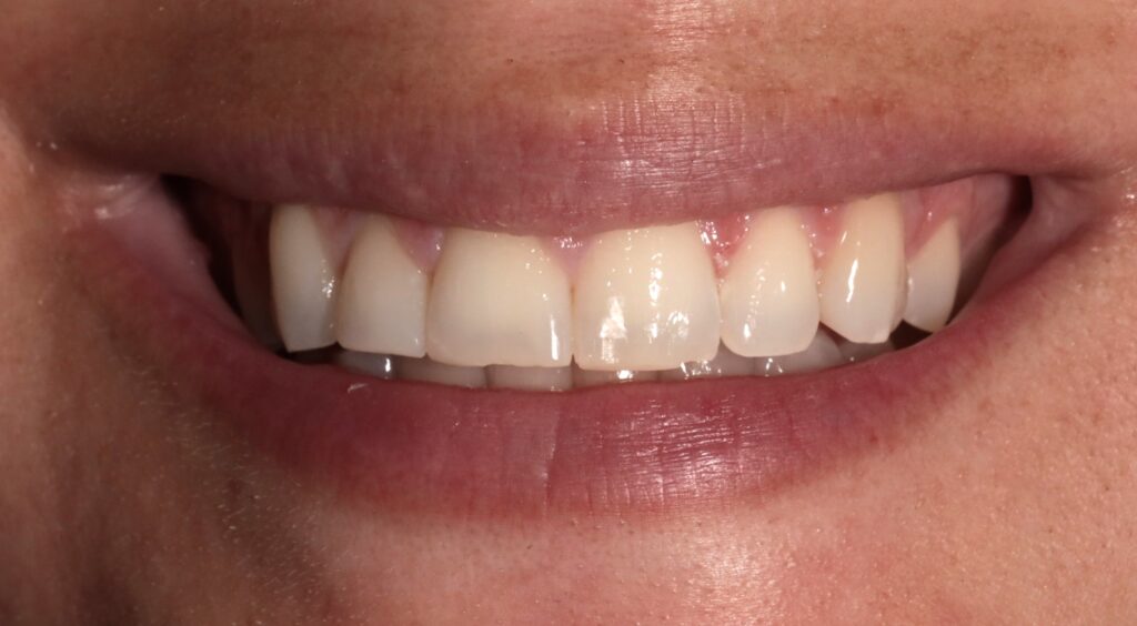 1 Before Dental Veneers Porcelain V