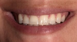 1 Before Dental Veneers Porcelain V