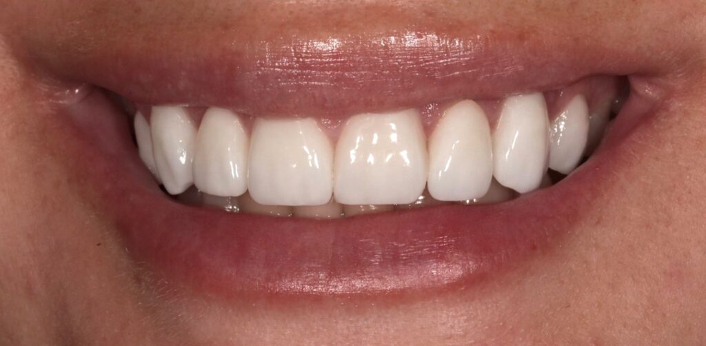 1 After Dental Veneers Porcelain V