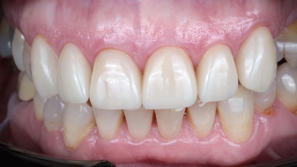 2 After Dental Veneers Porcelain V