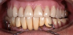 Mr A.M - Upper all on X 2 Before Dental Implants