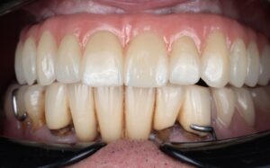 Mr A.M - Upper all on X 2 Before Dental Implants