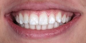 5 After Dental Invisalign